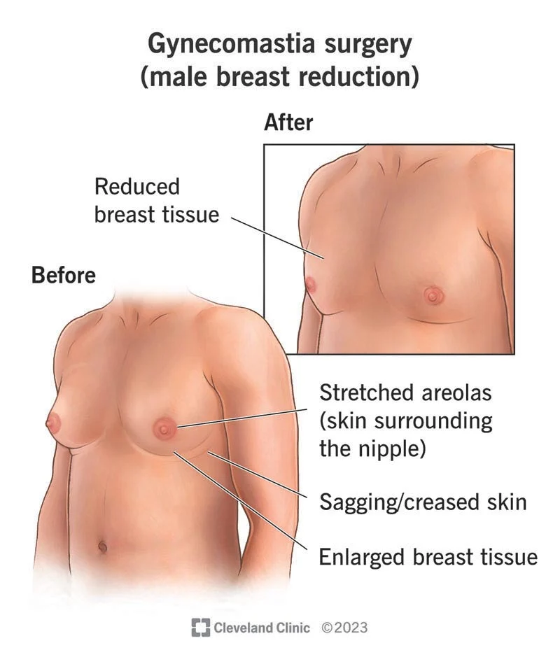 Understanding the Medical Necessity for Gynecomastia Surgery